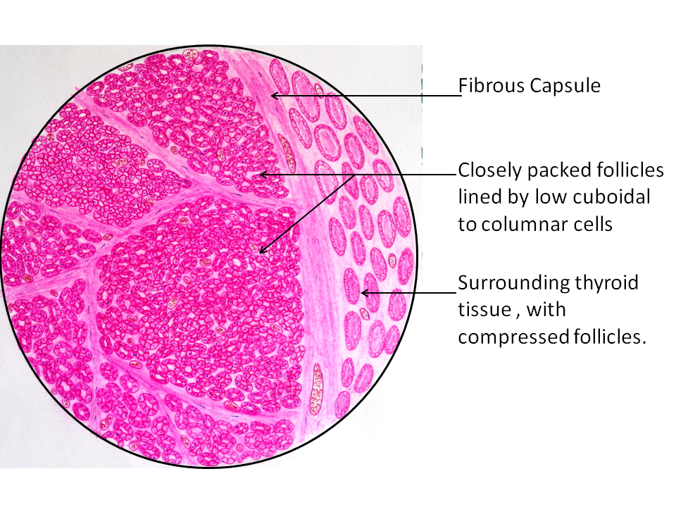 thyroid adenoma histology