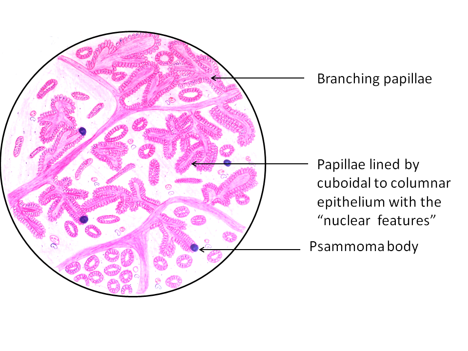 papillary thyroid cancer psammoma bodies