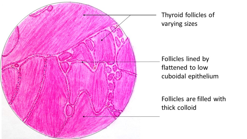 Colloid Goiter | Pathology Made Simple