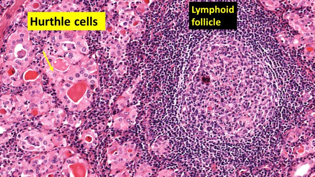 Hashimotos Thyroiditis Histology