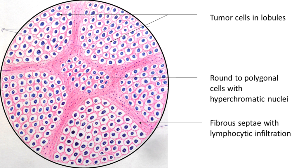 dysgerminoma- ovary