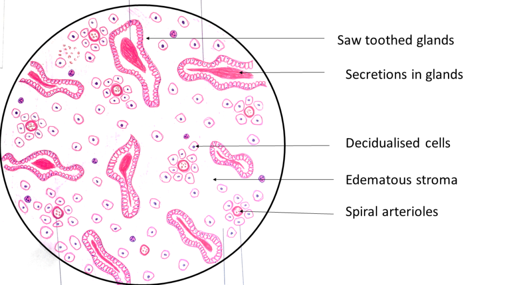 Pathology secretory endometrium Dyssynchronous secretory