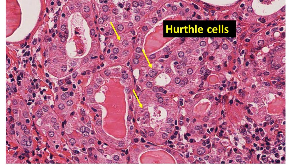 hashimotos-thyroiditis-pathology-made-simple