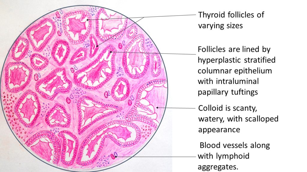 Toxic Goiter Other Name