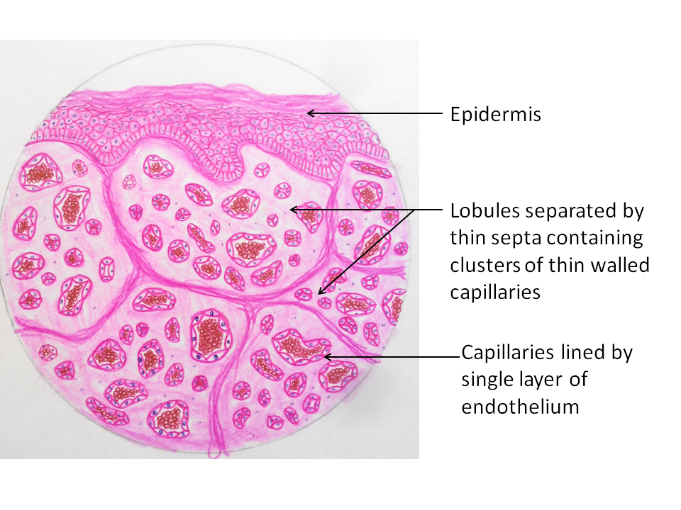 capillary-hemangioma-pathology-made-simple