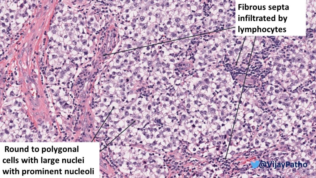 dysgerminoma electron microscopy