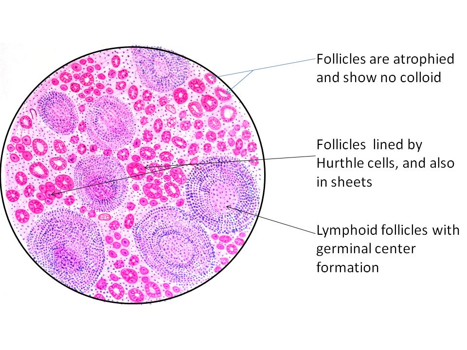 hashimotos-thyroiditis-pathology-made-simple