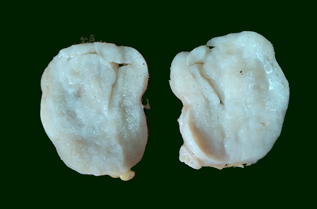 fibroadenoma gross