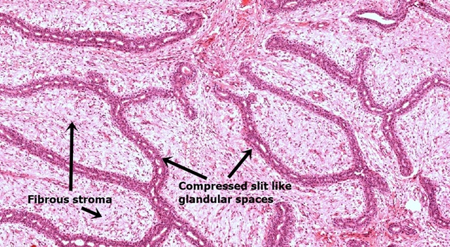 fibroadenoma m1