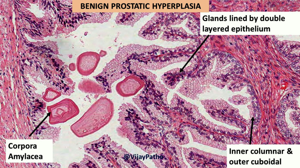 benign prostate hyperplasia pathology outlines