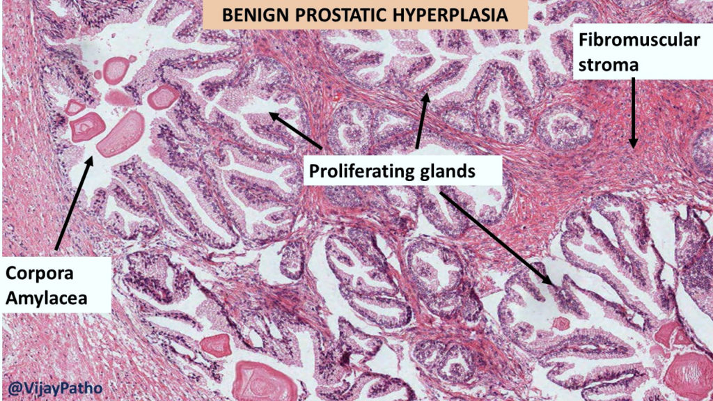 benign prostate hyperplasia pathology outlines