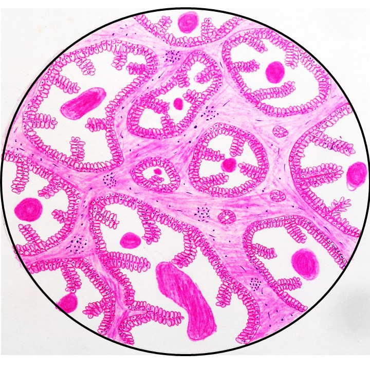 benign prostatic hyperplasia pathology