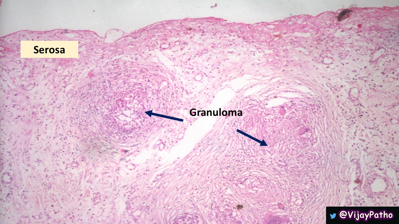 Intestinal Tuberculosis - Pathology Made Simple