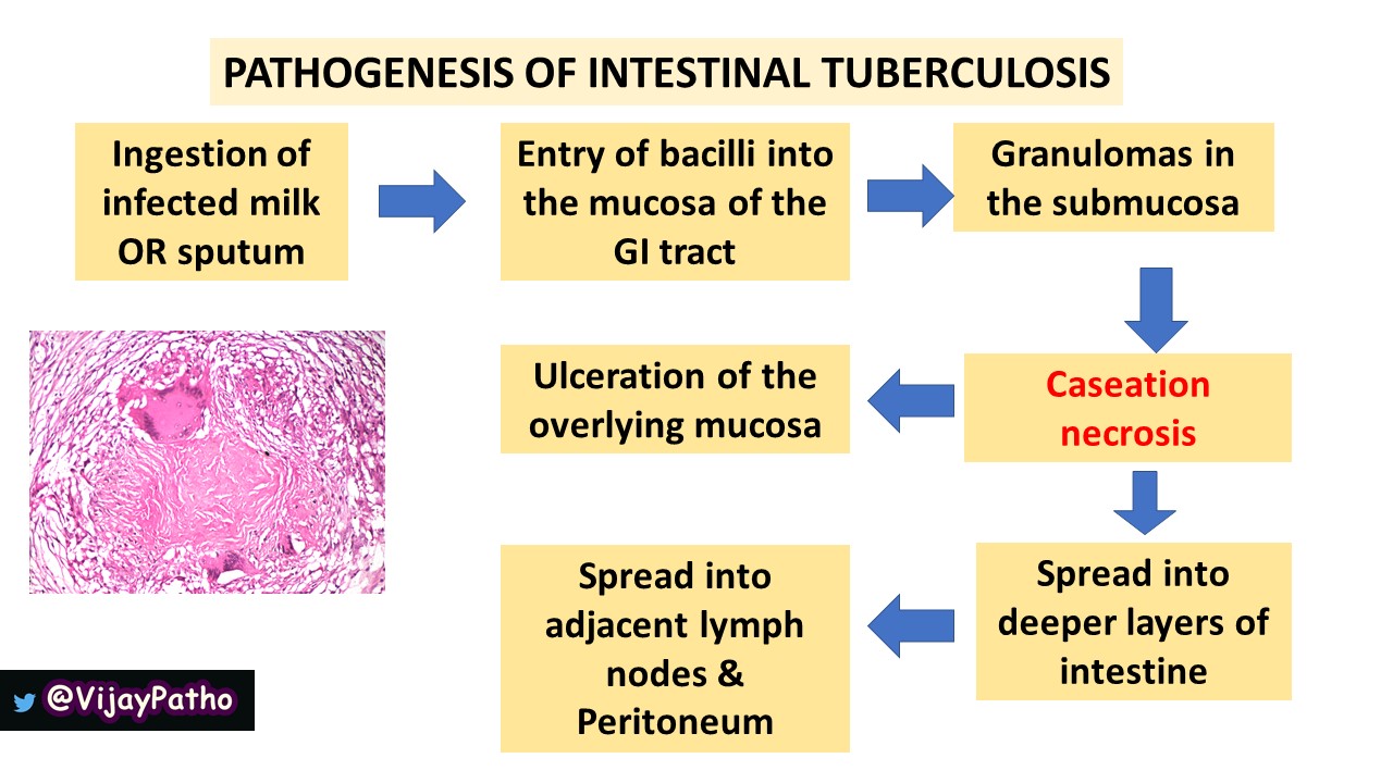 Intestinal Tuberculosis - Pathology Made Simple