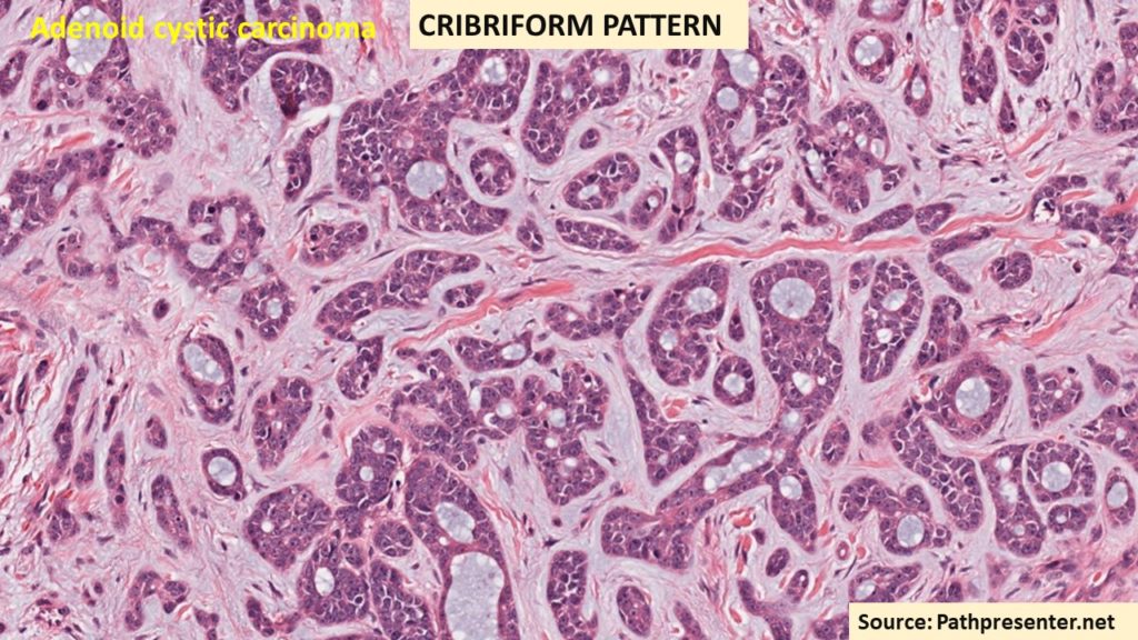 CRIBRIFORM PATTERN : #patternsinhistopathology - Pathology Made Simple