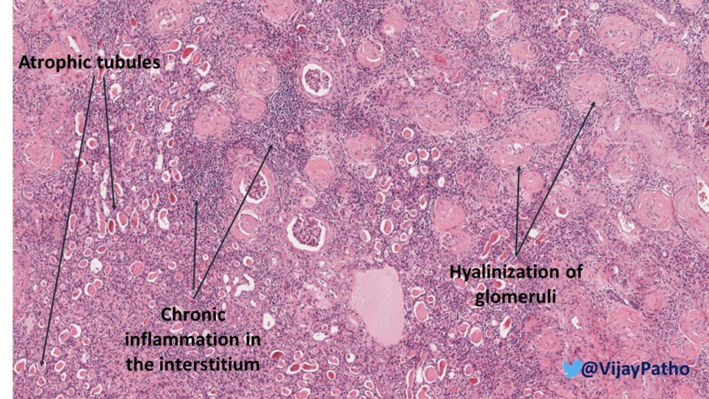 chronic pyelonephritis histology