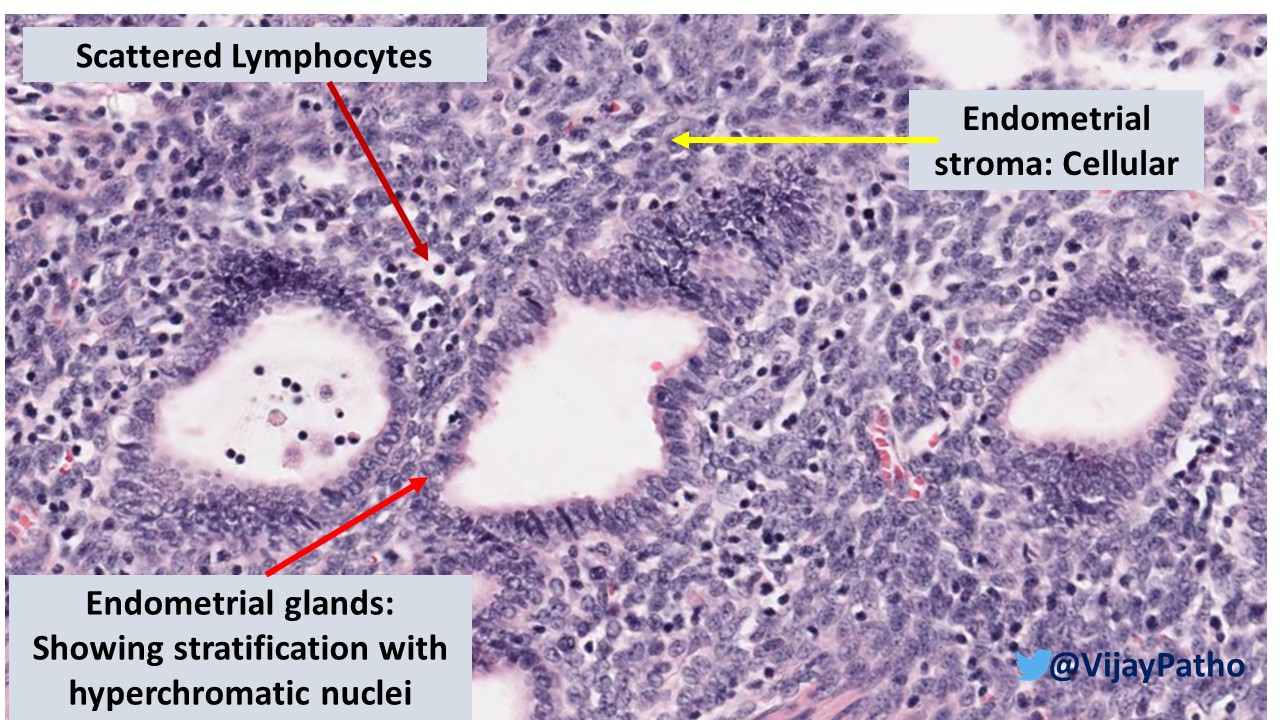 Endometriosis Pathology Made Simple