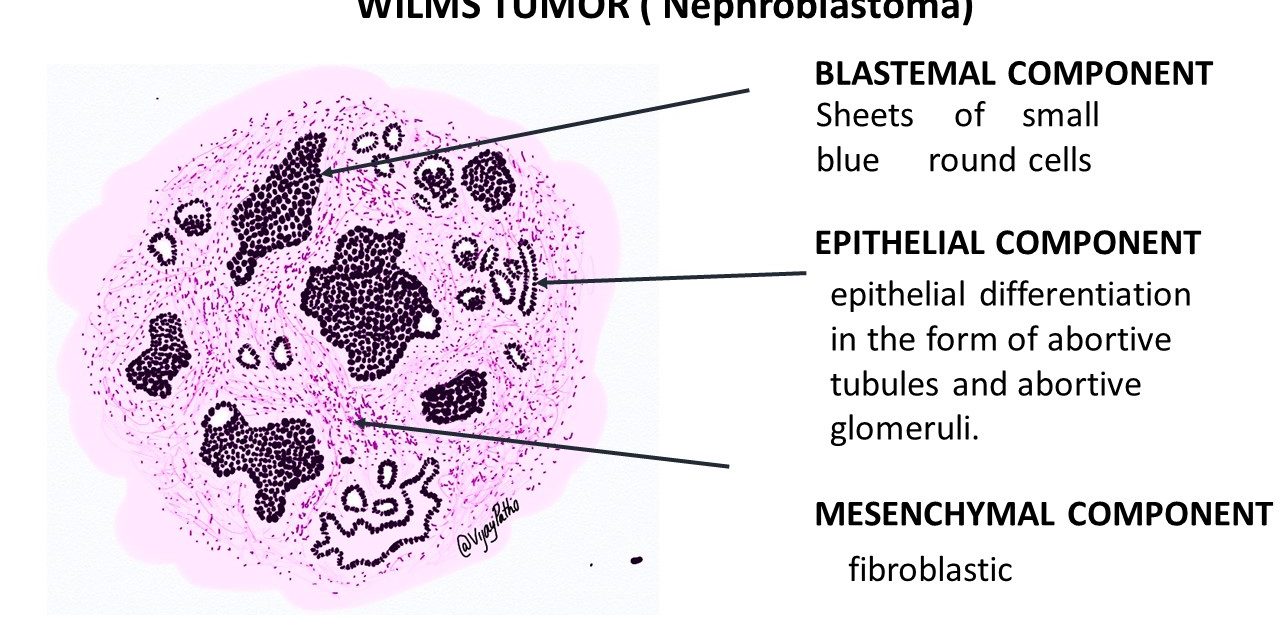 WILMS TUMOR( NEPHROBLASTOMA) Pathology Made Simple.