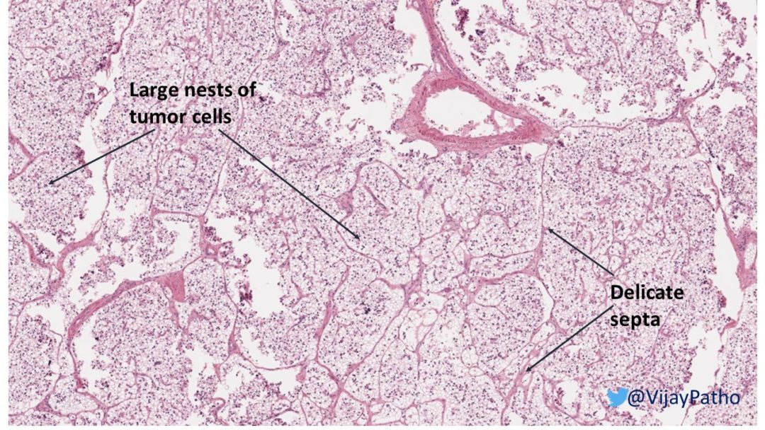 Renal Cell Carcinoma Clear Cell Type Pathology Made Simple 8673