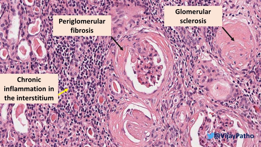 chronic pyelonephritis histology