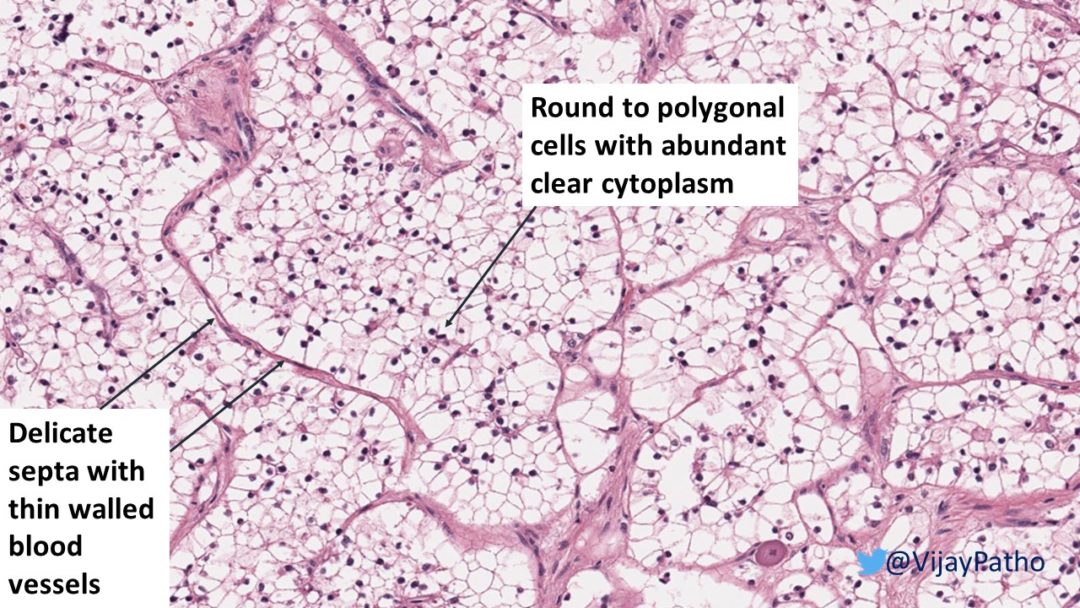 RENAL CELL CARCINOMA- CLEAR CELL TYPE | Pathology Made Simple