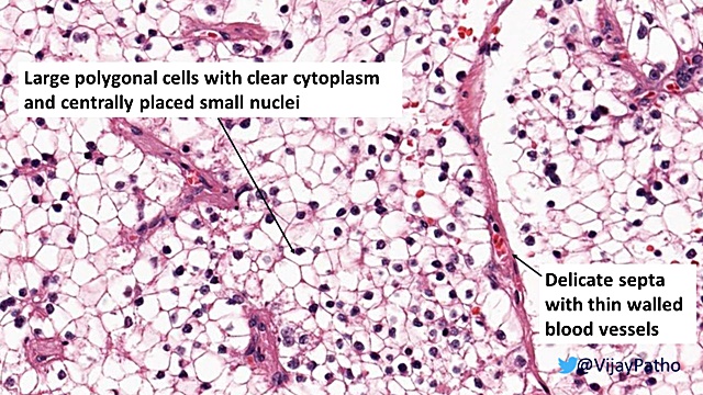 renal-cell-carcinoma-clear-cell-type-pathology-made-simple