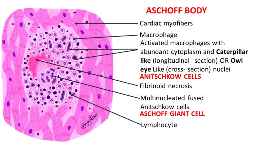 ACUTE RHEUMATIC FEVER Pathology Made Simple