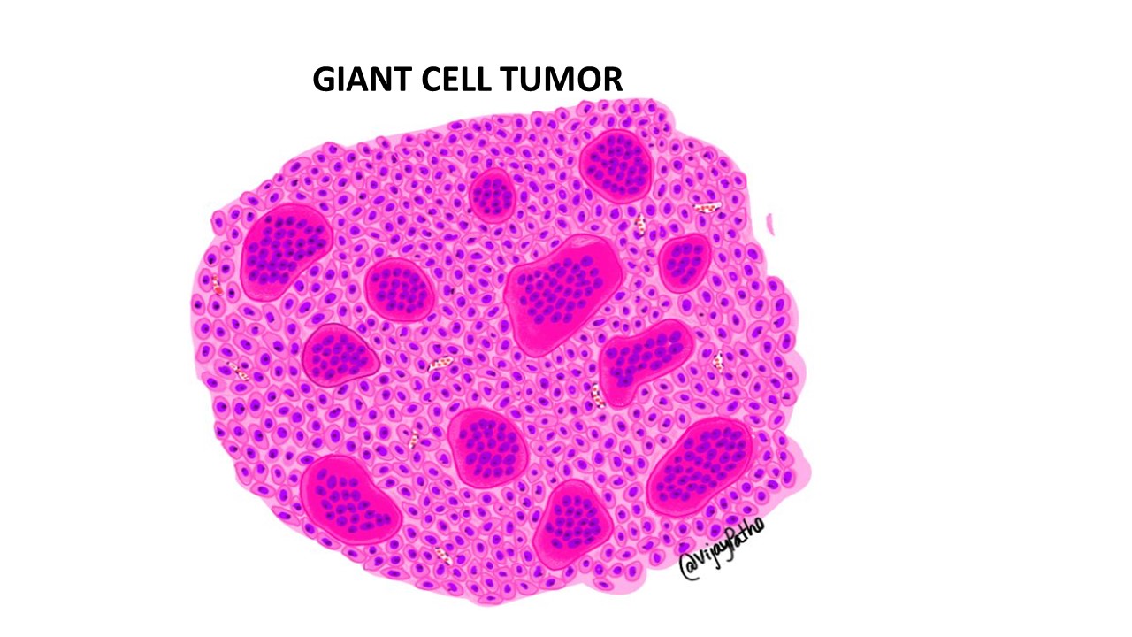 GIANT CELL TUMOR- BONE - Pathology Made Simple