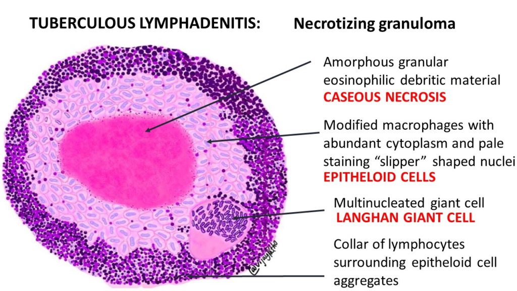 Tuberculosis Histology Histopathology Tuberculosis Light Micrograph Tuberculosis Histology Histopathology Tuberculosis Light Micrograph