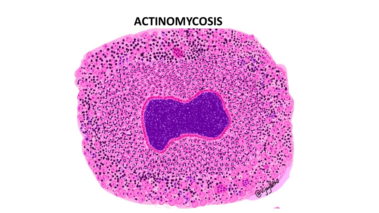 Actinomycosis Pathology Made Simple 