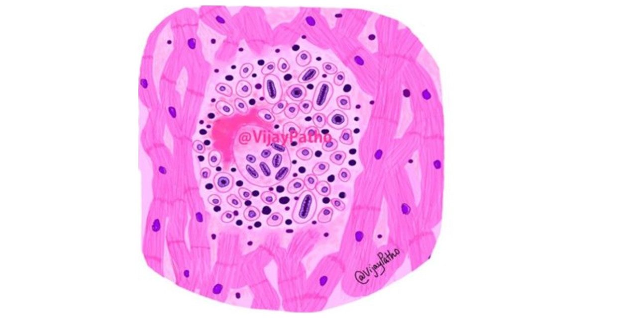 acute-rheumatic-fever-pathology-made-simple