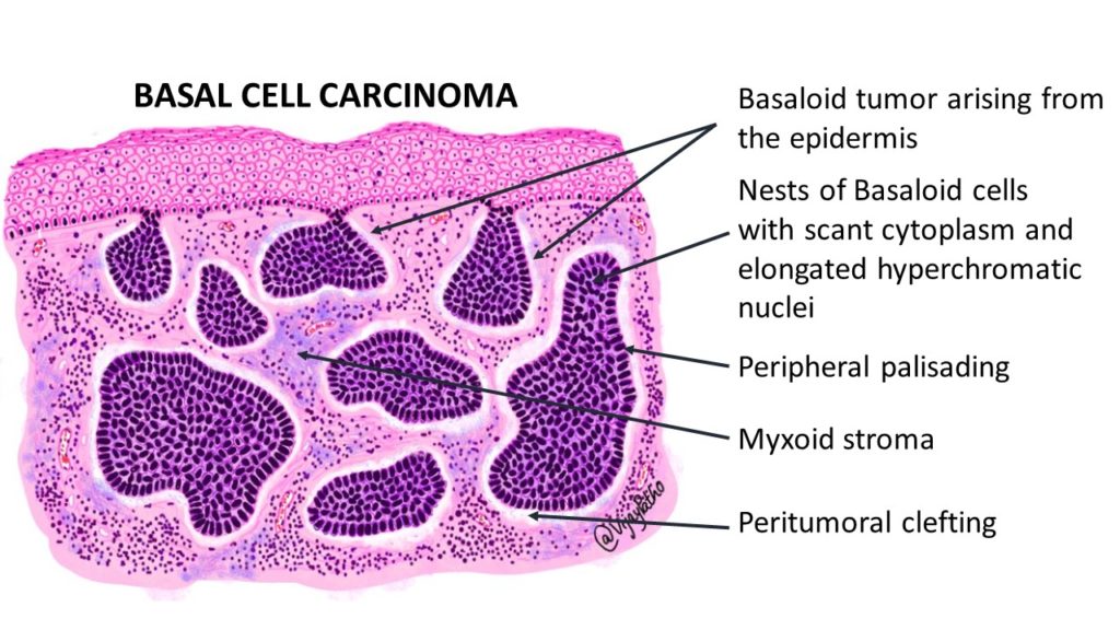 Basal Cell Carcinoma Pathology Made Simple