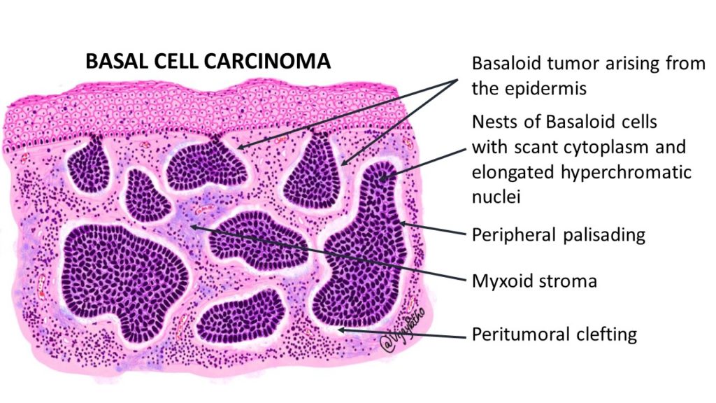 basal cell carcinoma vs squamous cell carcinoma histology