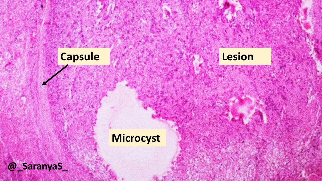 Pathology Of Schwannoma Pathology Made Simple 5046