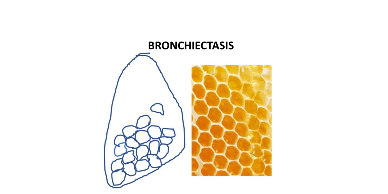 bronchiectasis histology