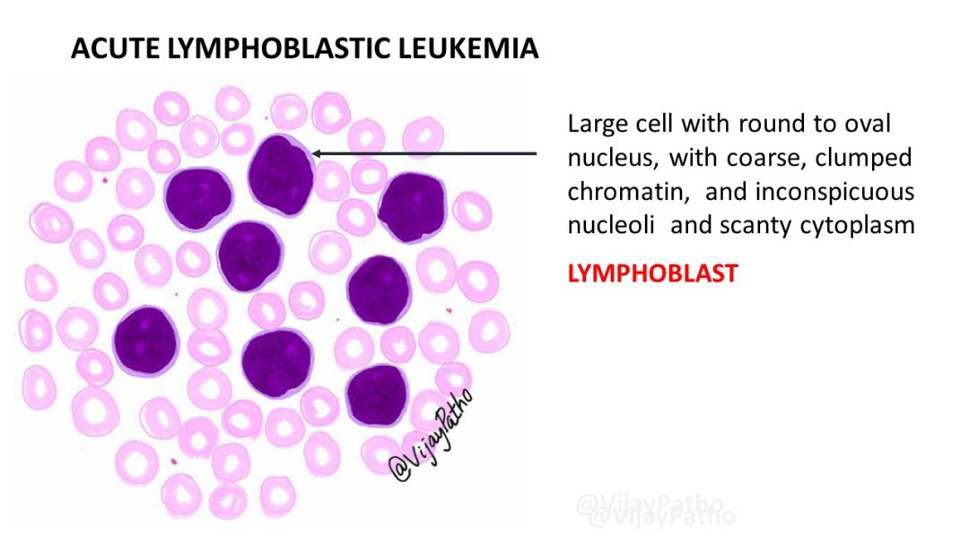 high ag ratio leukemia