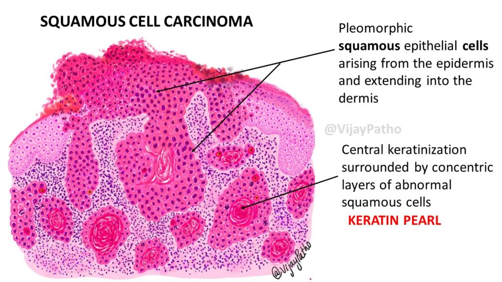 squamous cell carcinoma skin histology