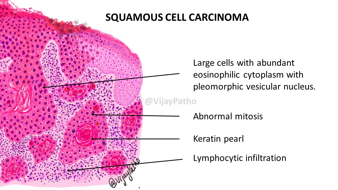 Pathology Of SQUAMOUS CELL CARCINOMA | Pathology Made Simple