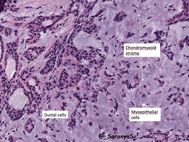 Pleomorf adenoma pathology. A fejemet prosztata adenoma fáj