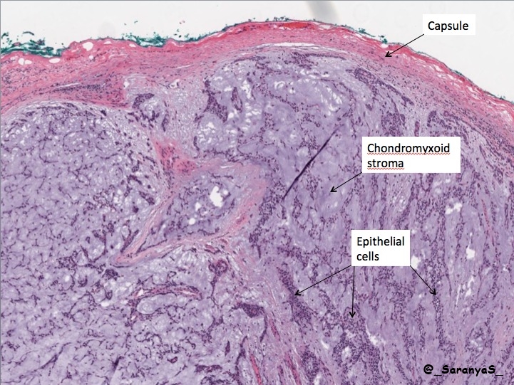 pleomorphic adenoma pathology outlines)