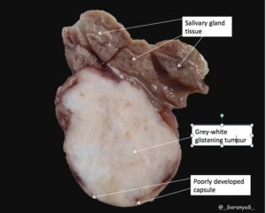 Pathology Of Pleomorphic Adenoma Pathology Made Simple