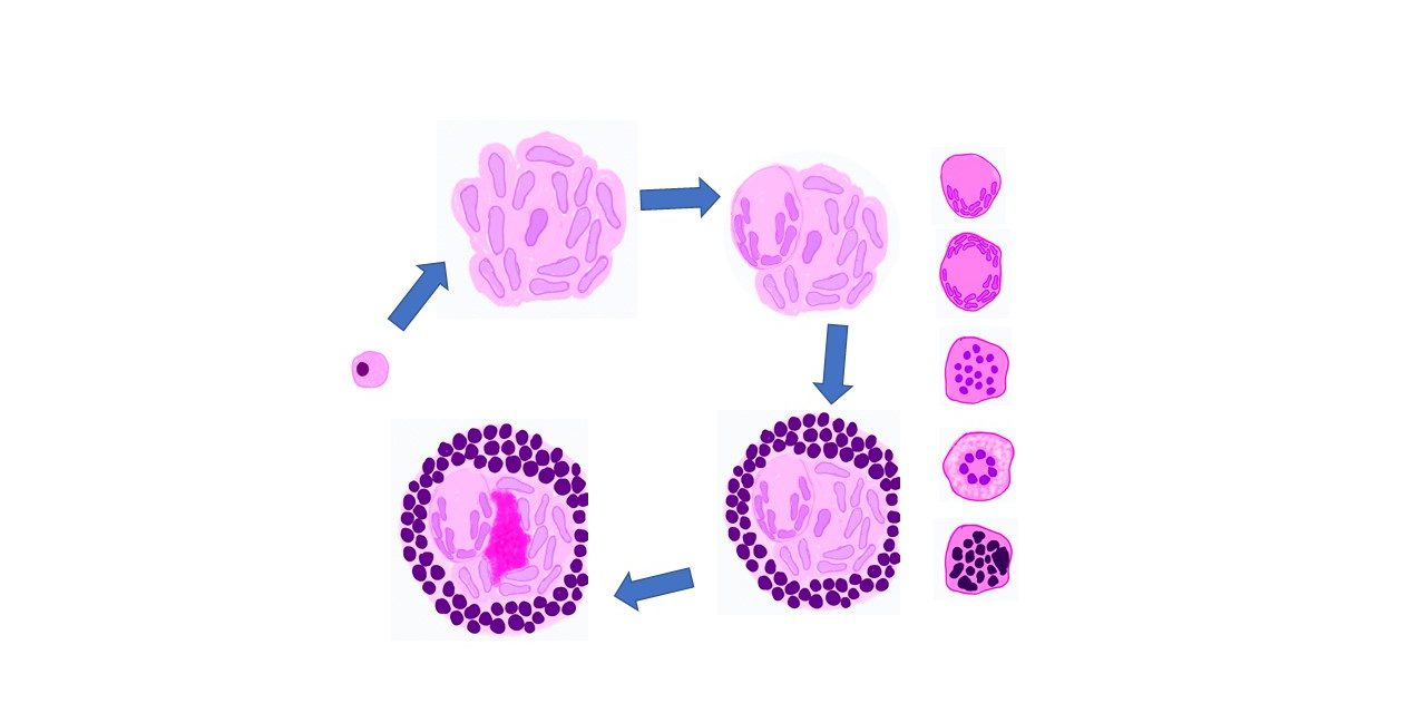 GRANULOMATOUS INFLAMMATION  Pathology Made Simple