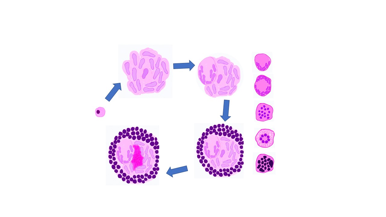 GRANULOMATOUS INFLAMMATION Pathology Made Simple