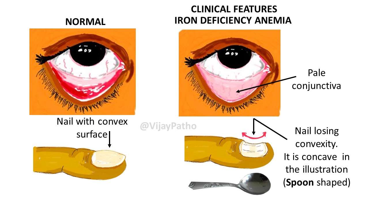 pica iron deficiency