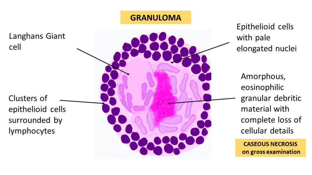 Chronic Inflammation,Granulomatous Dieases,Tuberculosis 