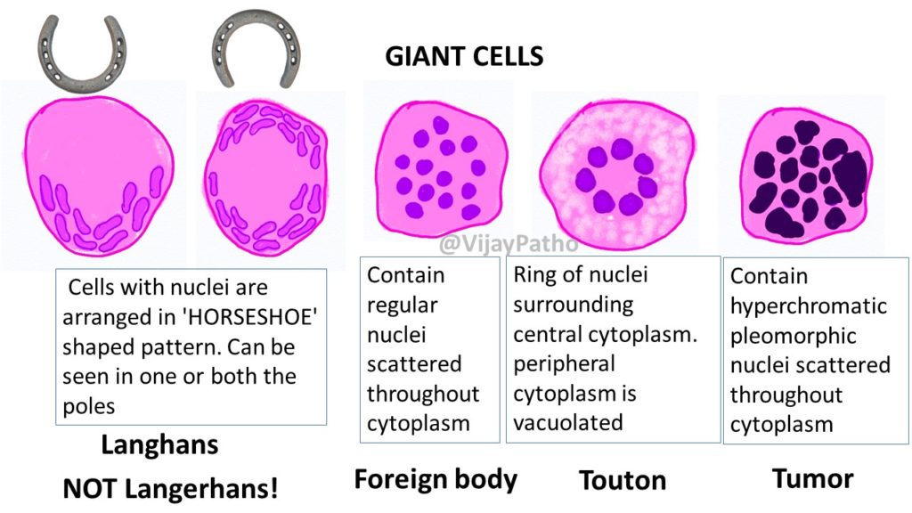 GRANULOMATOUS INFLAMMATION  Pathology Made Simple