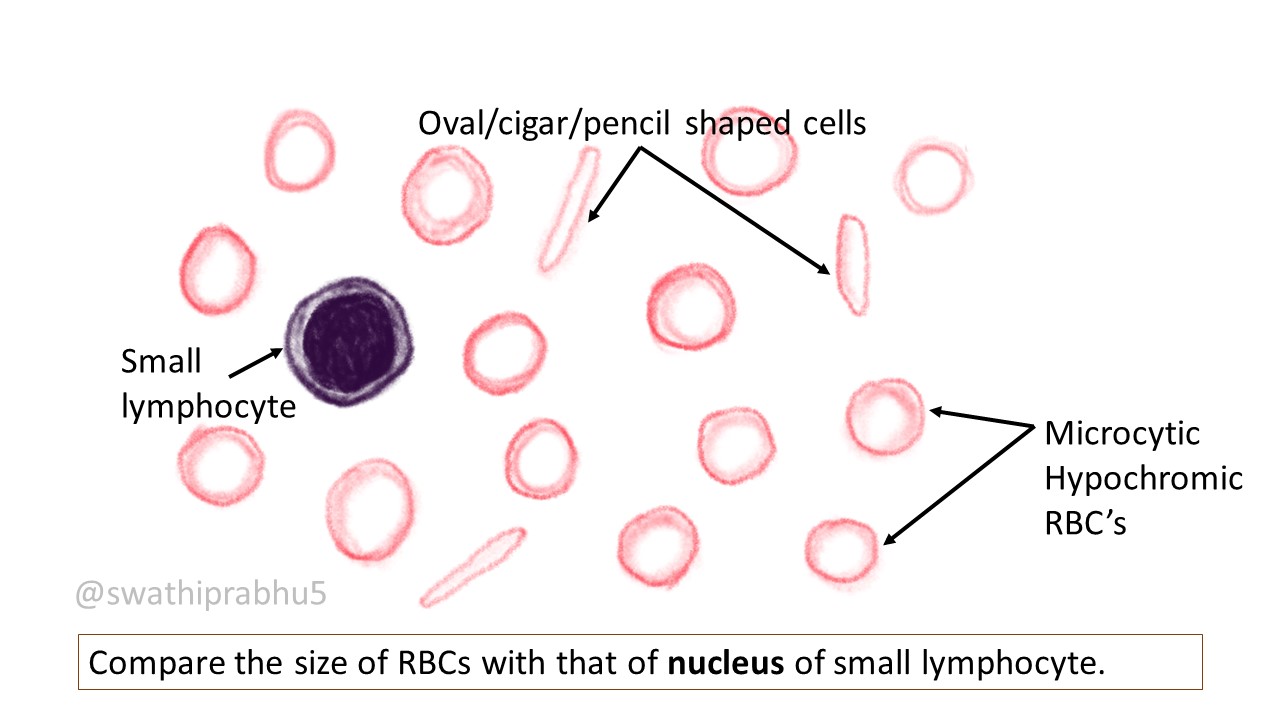 Pathology Of Iron Deficiency Anemia - Pathology Made Simple