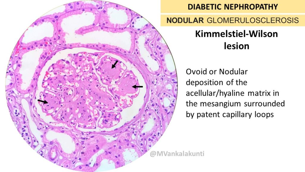 diabetic nephropathy pathology