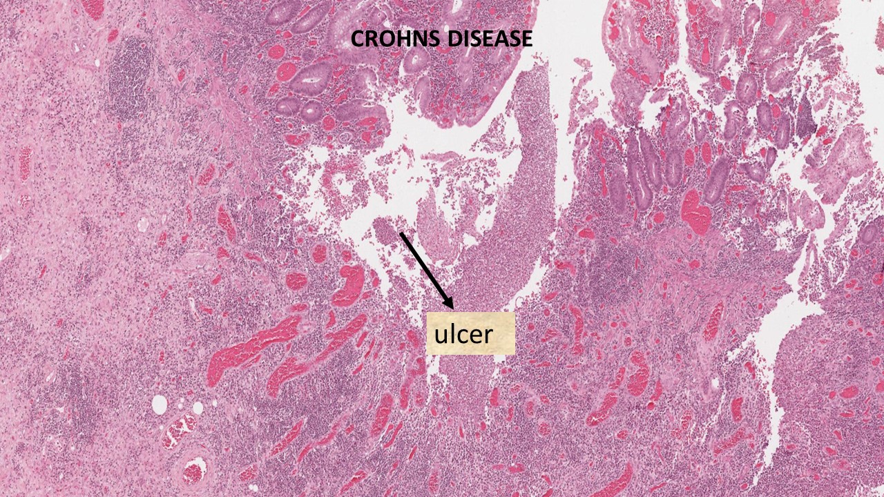 Pathology Of Crohn's Disease - Pathology Made Simple