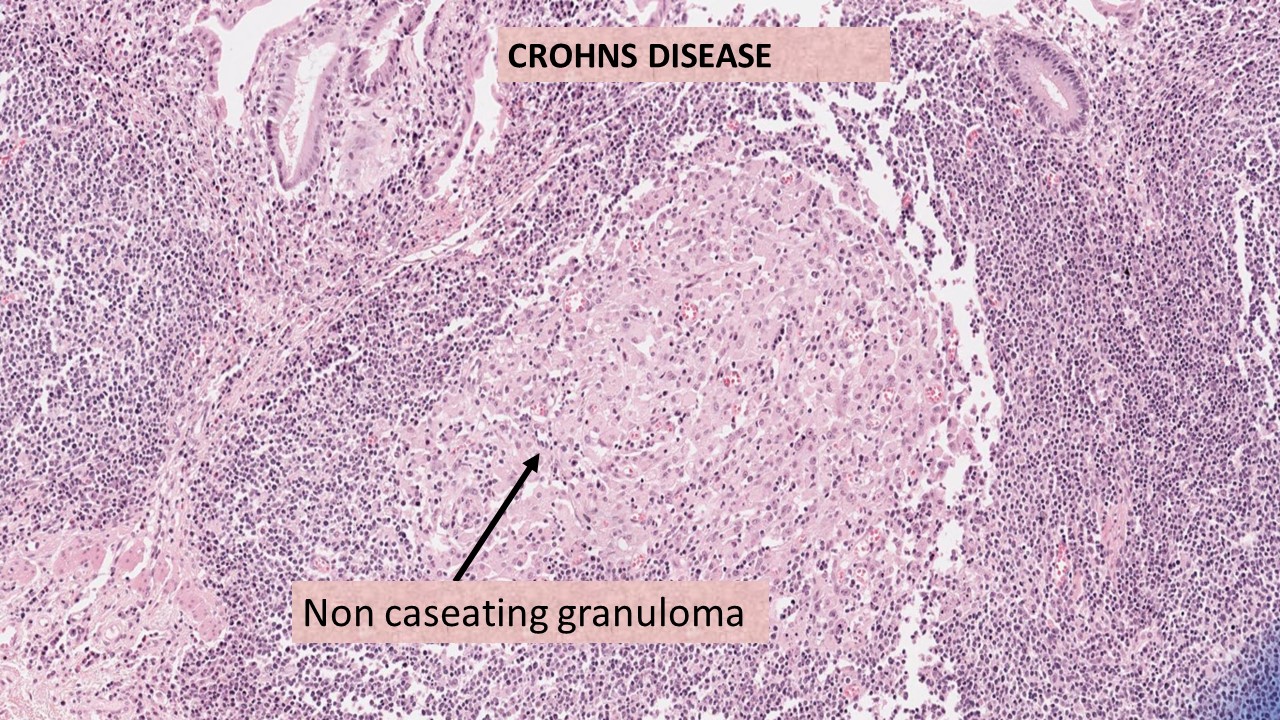 Pathology of Crohn's Disease Pathology Made Simple